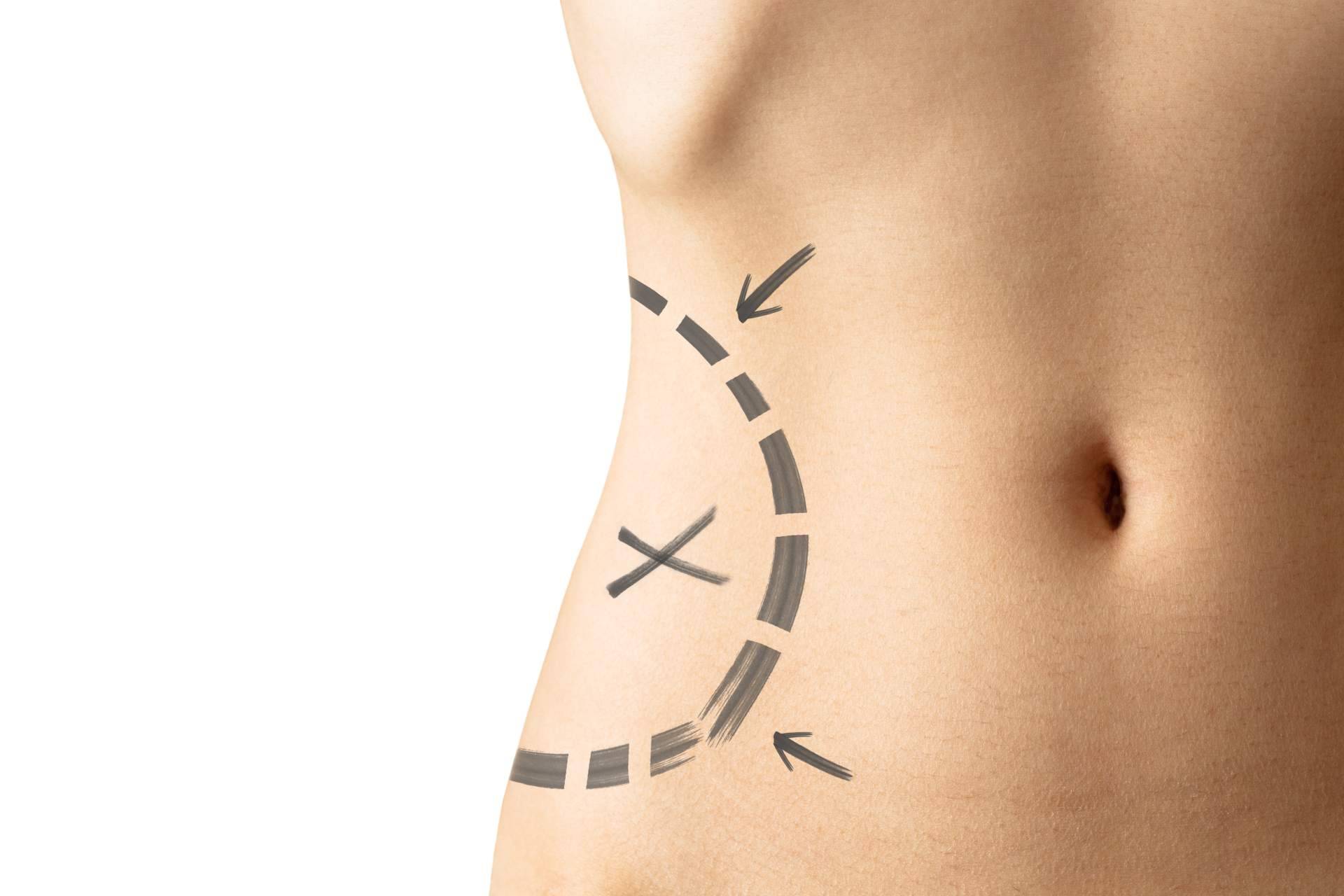 ¿Cuáles son las ventajas de la lipoescultura?, con A2Clínic