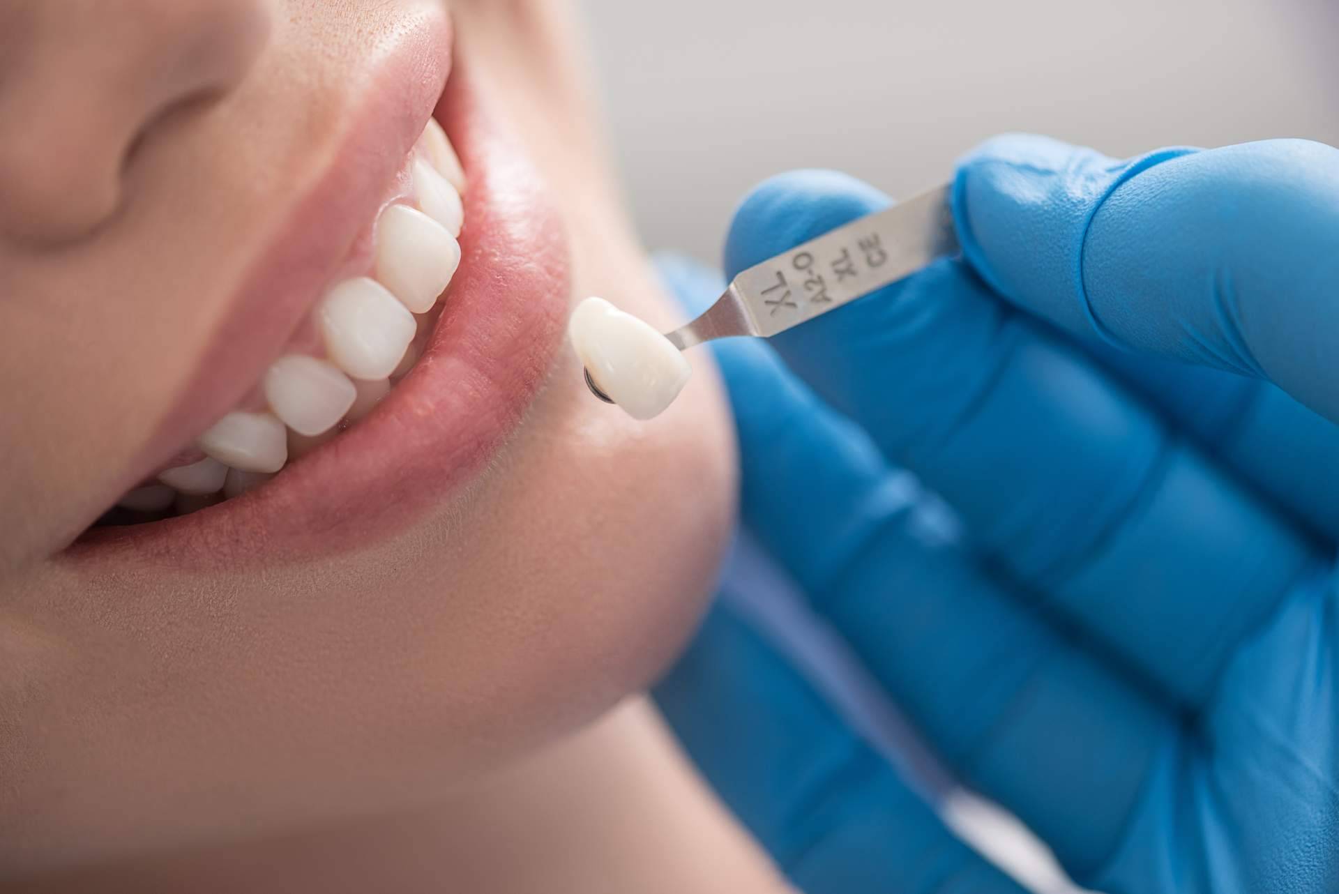 Clínica Dra. Elena Serrano, especialistas en rehabilitación oral mediante coronas dentales