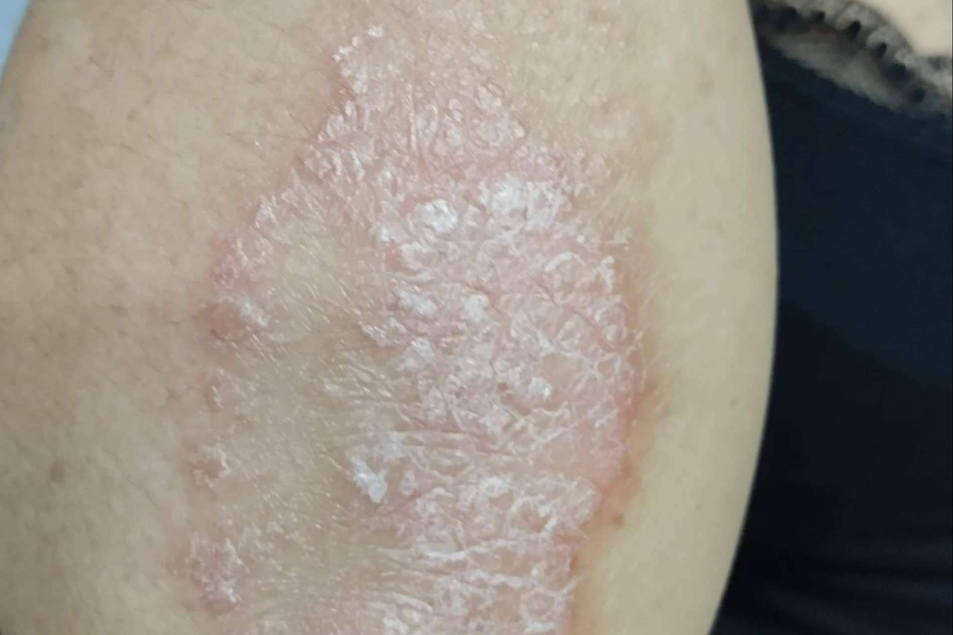 Nüwa trata los problemas de la piel mediante la acupuntura y la fototerapia