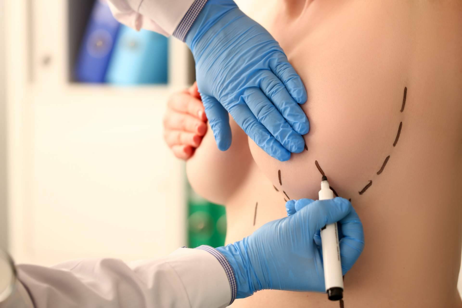 ¿Qué hay que tener en cuenta antes de realizarse un aumento de mamas?, con A2Clinic