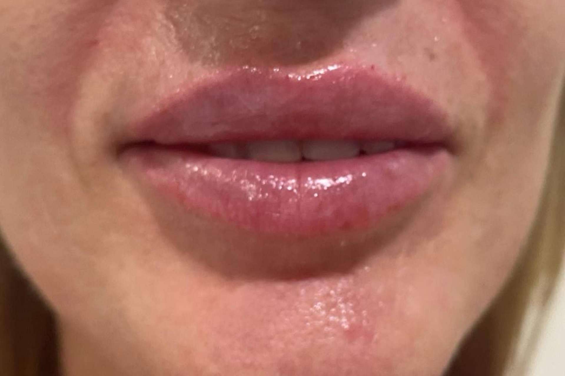Rellenos de ácido hialurónico para la remodelación y aumento de labios