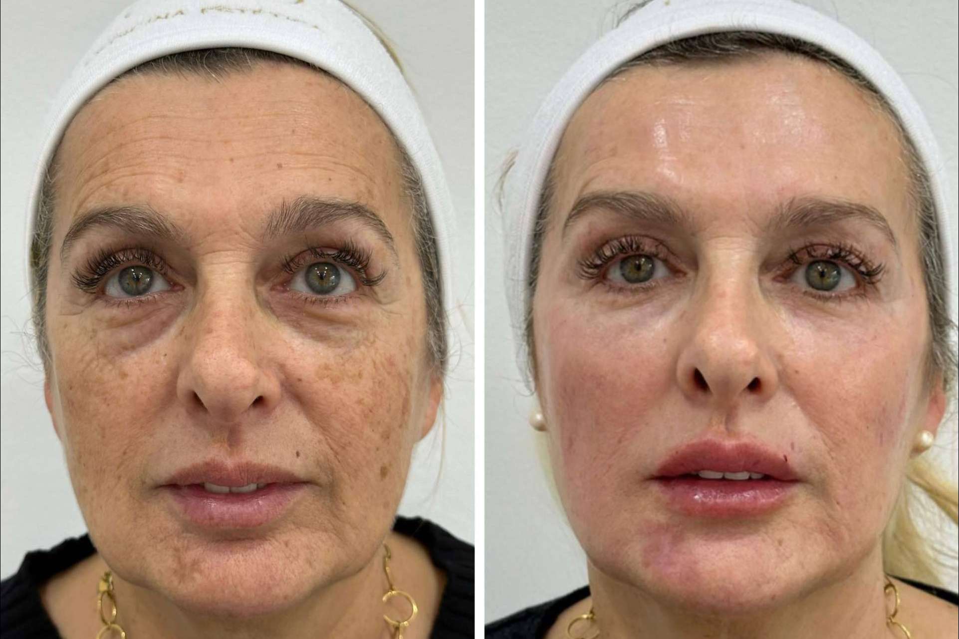 Clínica VISO sobre cómo combatir la flacidez facial