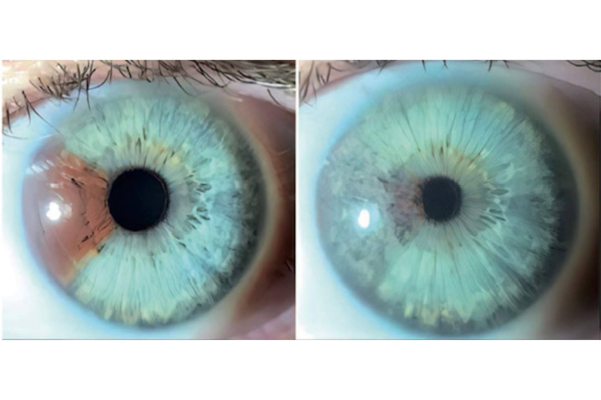 ¿Los heterocromías y los nevus del iris pueden ser tratados con láser? Clínica Eyecos