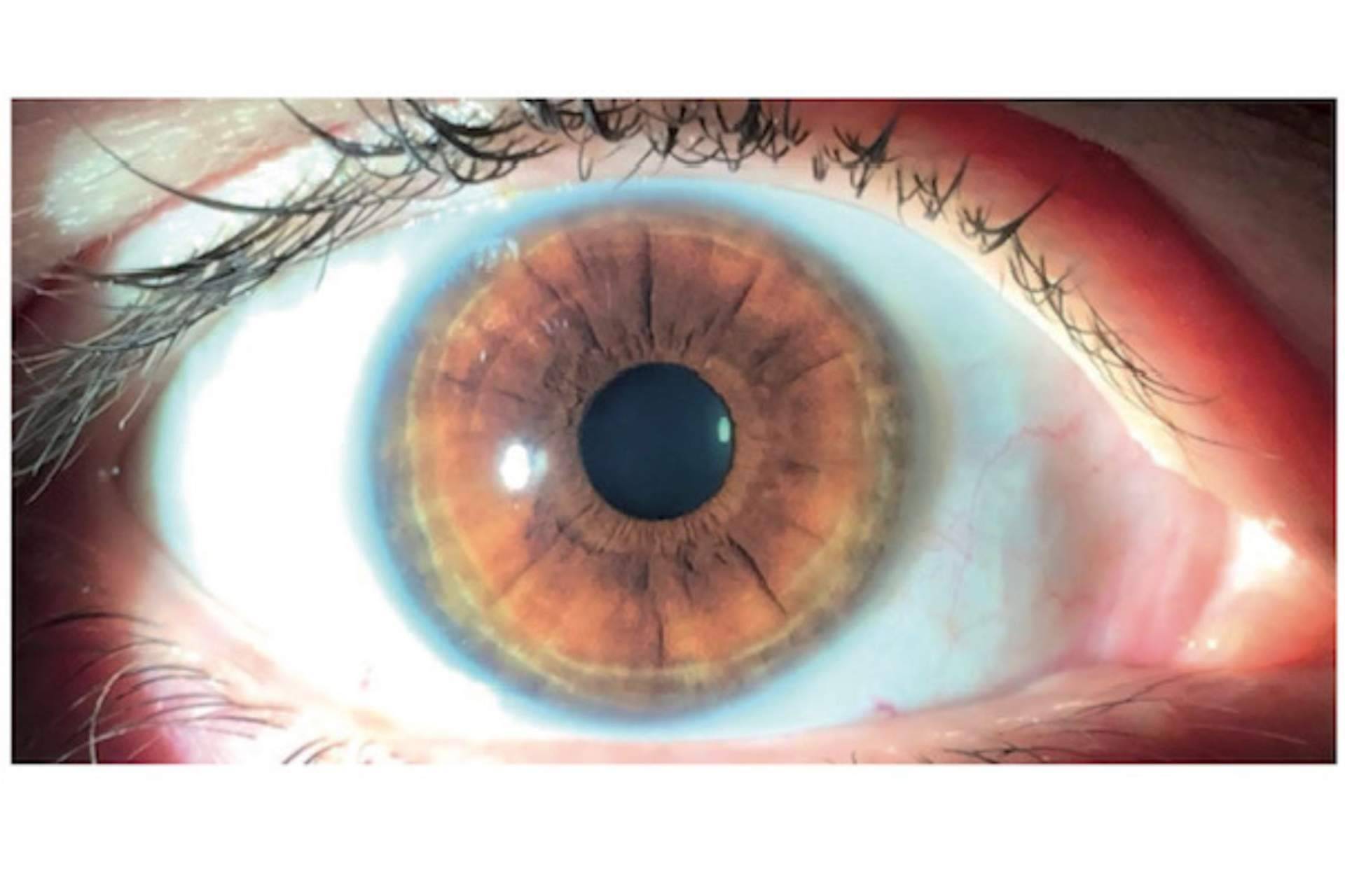 Clínica Eyecos expone que los productos crece pestañas pueden ocasionar un oscurecimiento de los ojos