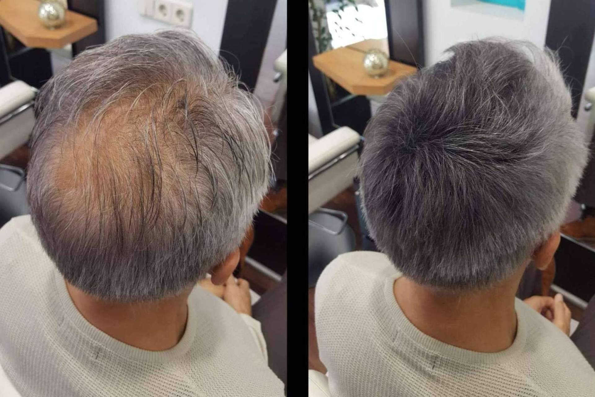 España es el segundo país del mundo con mayor tasa de pérdida de pelo, por Lion Hair