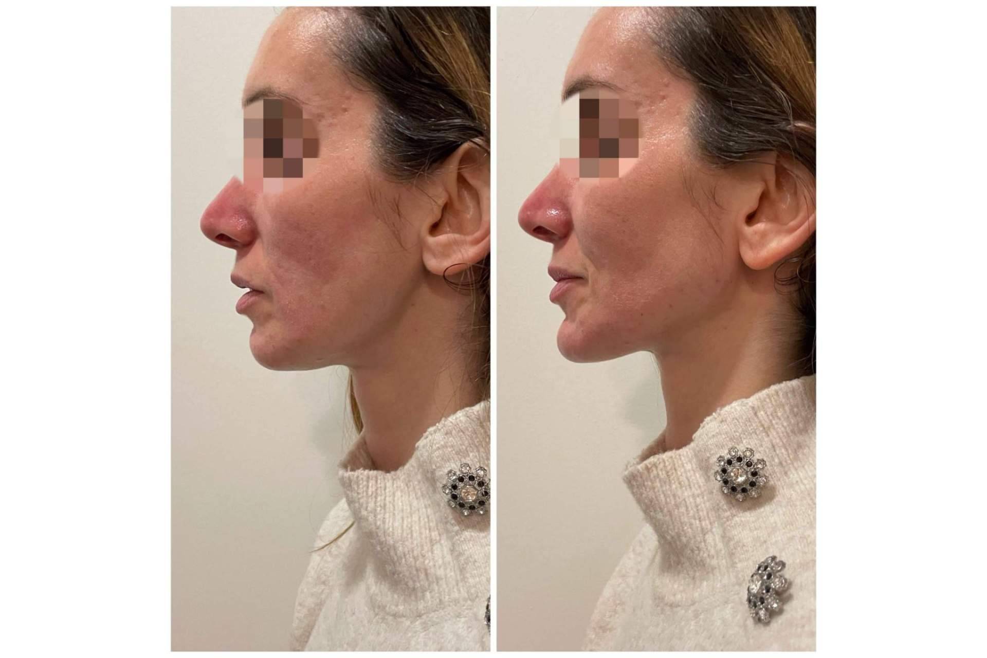 Dónde y por qué someterse a una marcación mandibular, con Cecilia Arthur