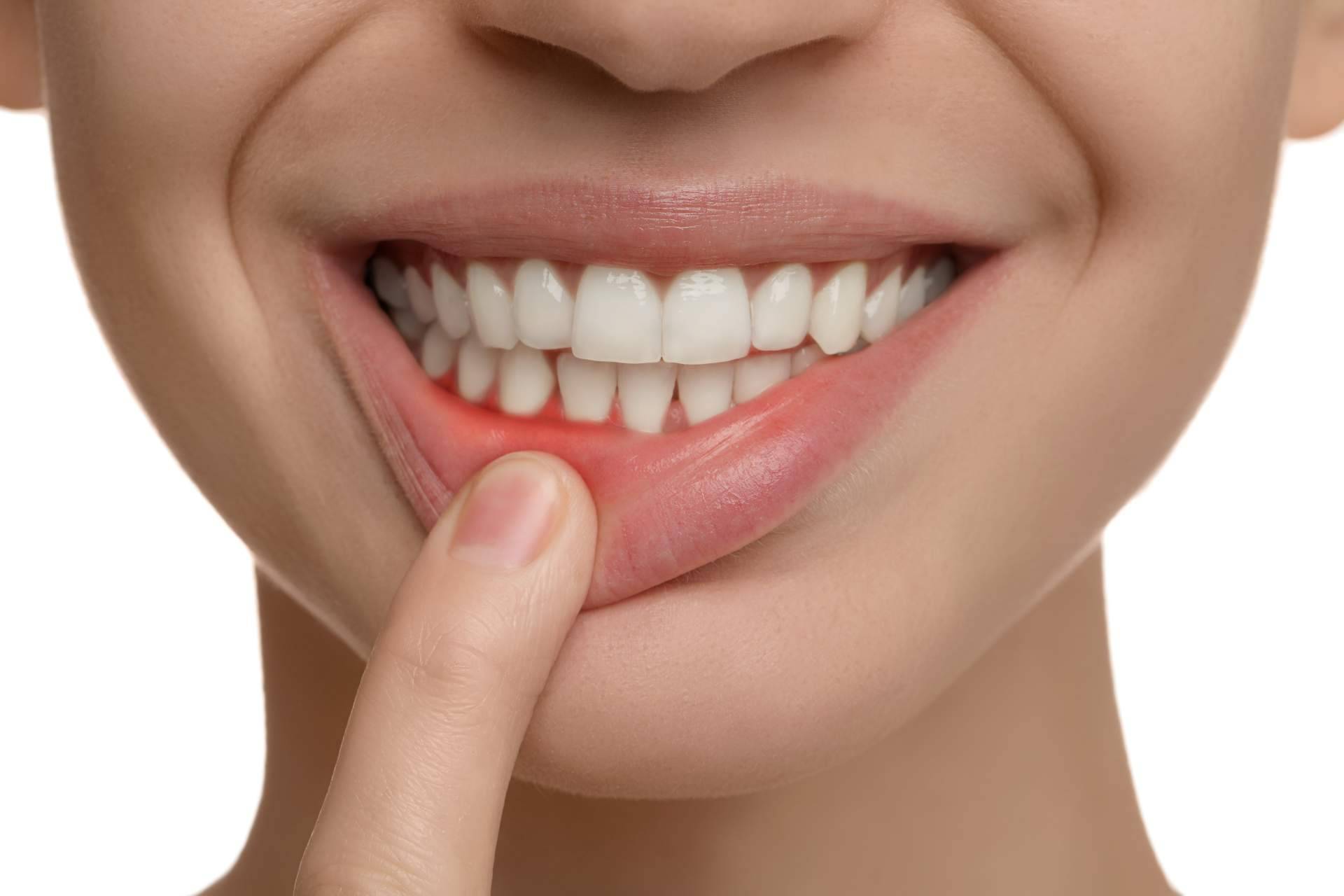 ¿Qué es la enfermedad de las encías y cómo tratarla según Clínica Dental Agudo Rosa?