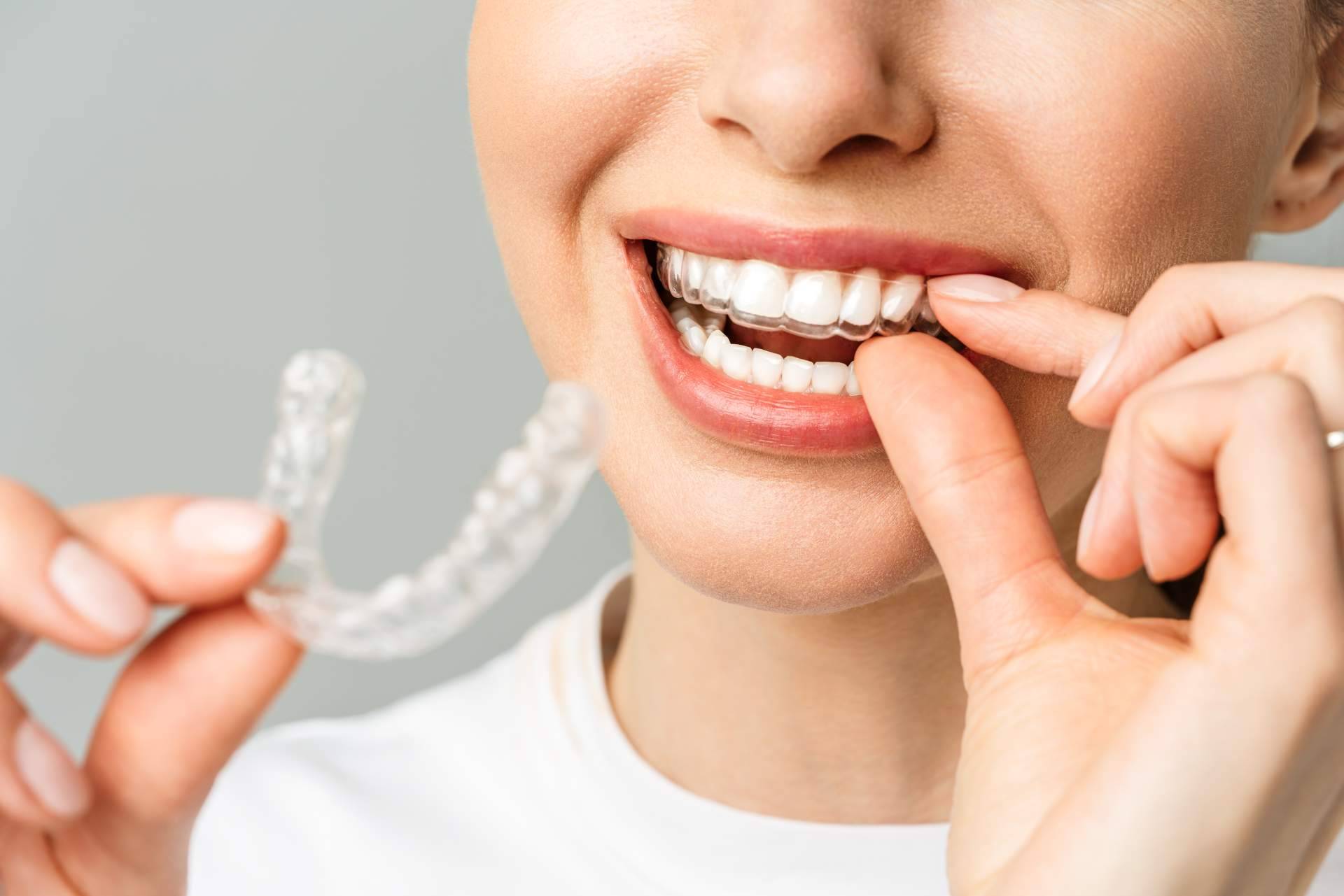 Clínica InterOralia ofrece un tratamiento Invisalign a precios competitivos y resultados excepcionales