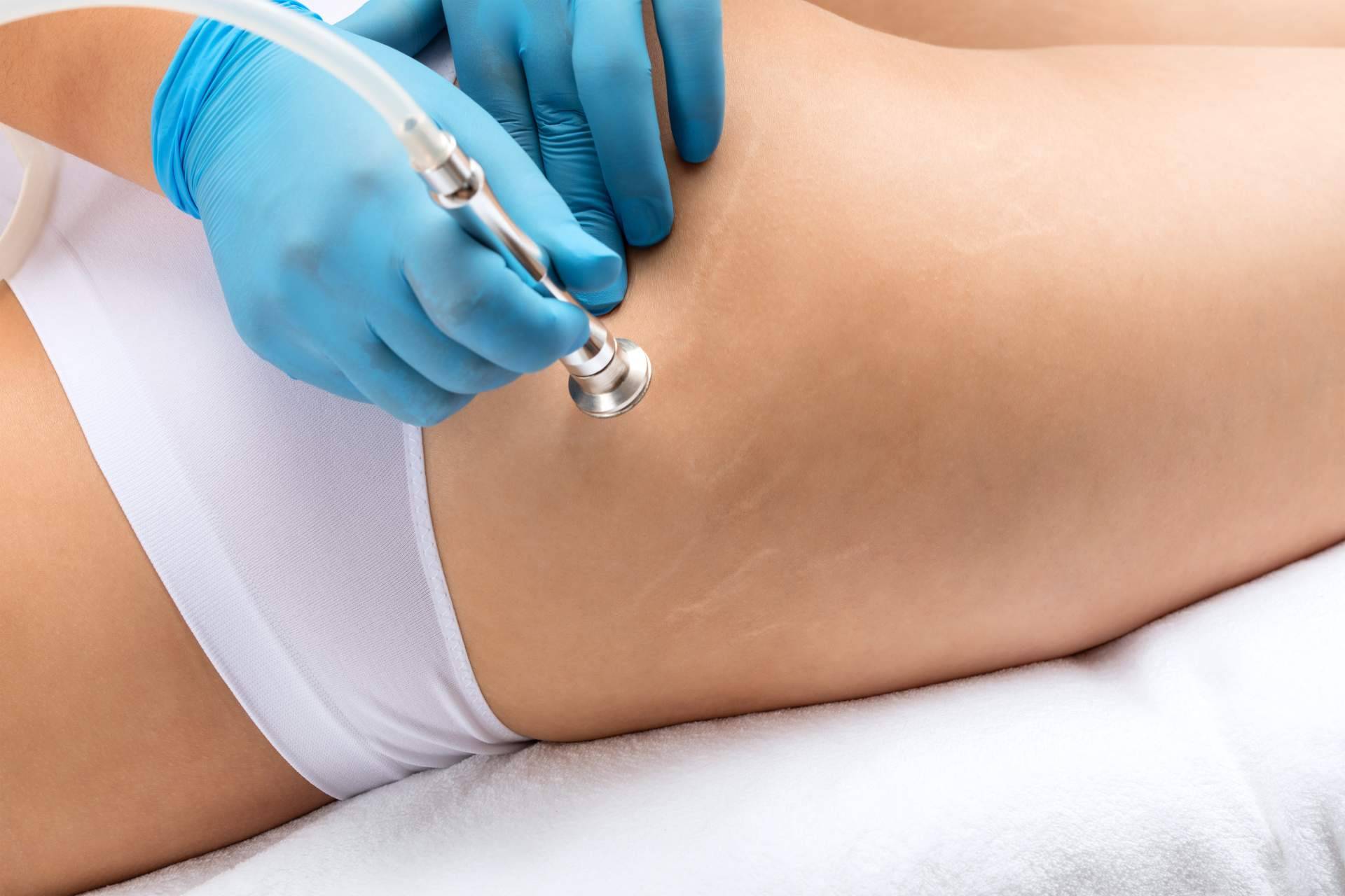 Centro Médico El Pilar, experiencia y resultados garantizados en la eliminación de estrías en Madrid