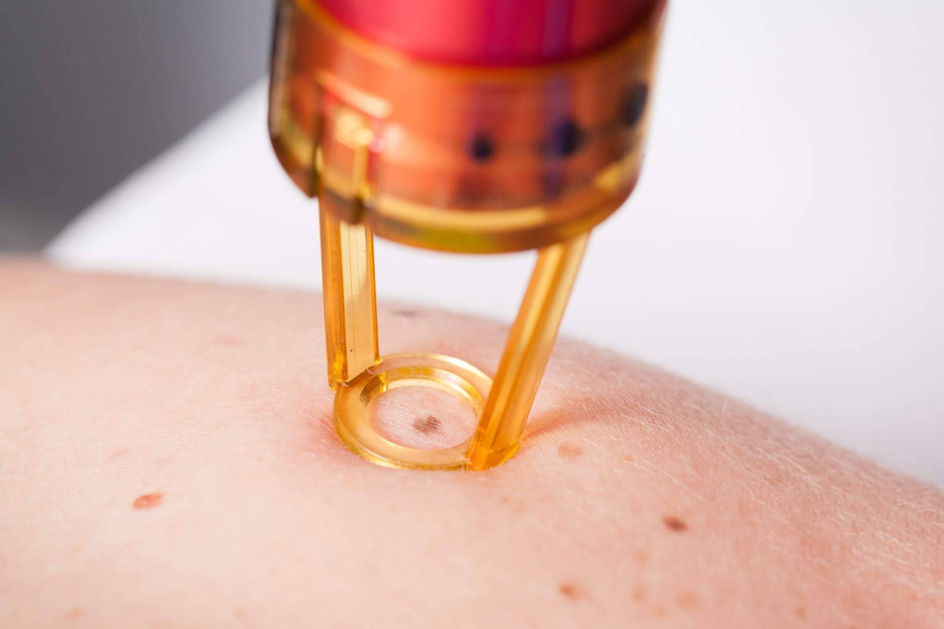 Eliminación de lunares y verrugas con los tratamientos más innovadores en Centro Estética El Pilar