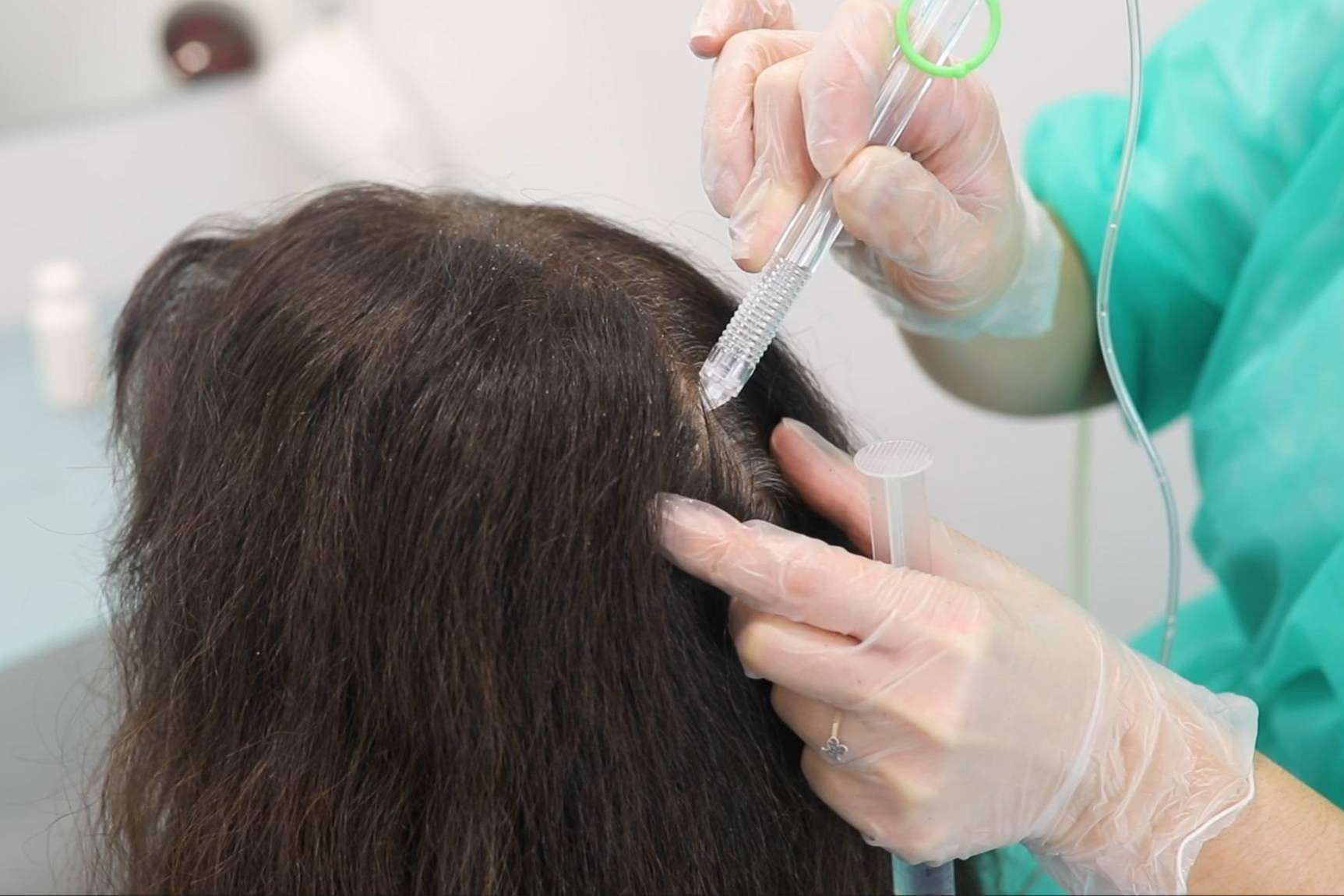 El tratamiento VitaX Regeneración con Minoxidil de IMD Instituto Médico Dermatológico frena la caída capilar
