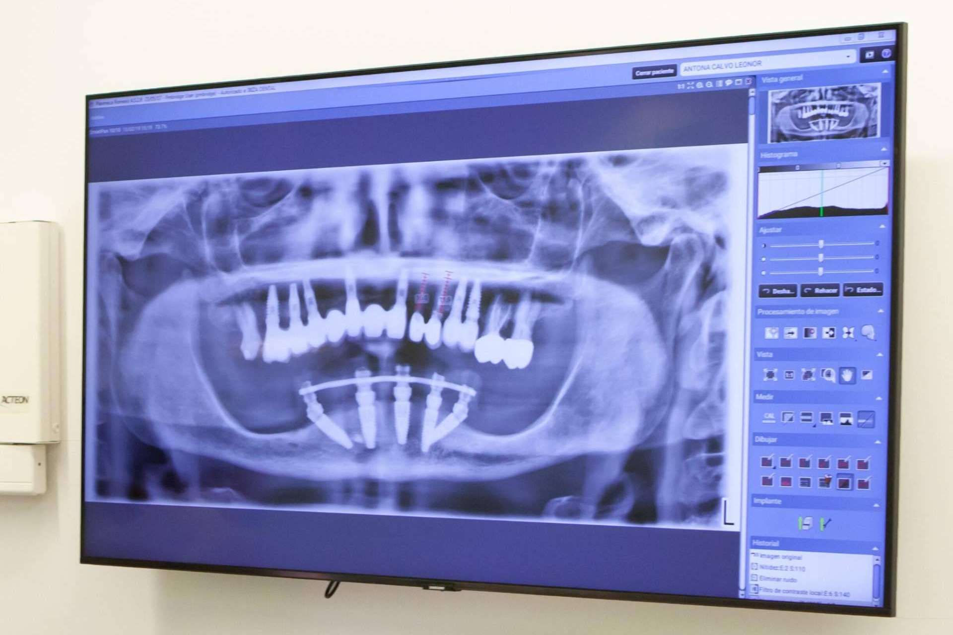 Clínica Dental Ruiz de Gopegui explica qué es el edentulismo y cómo tratarlo