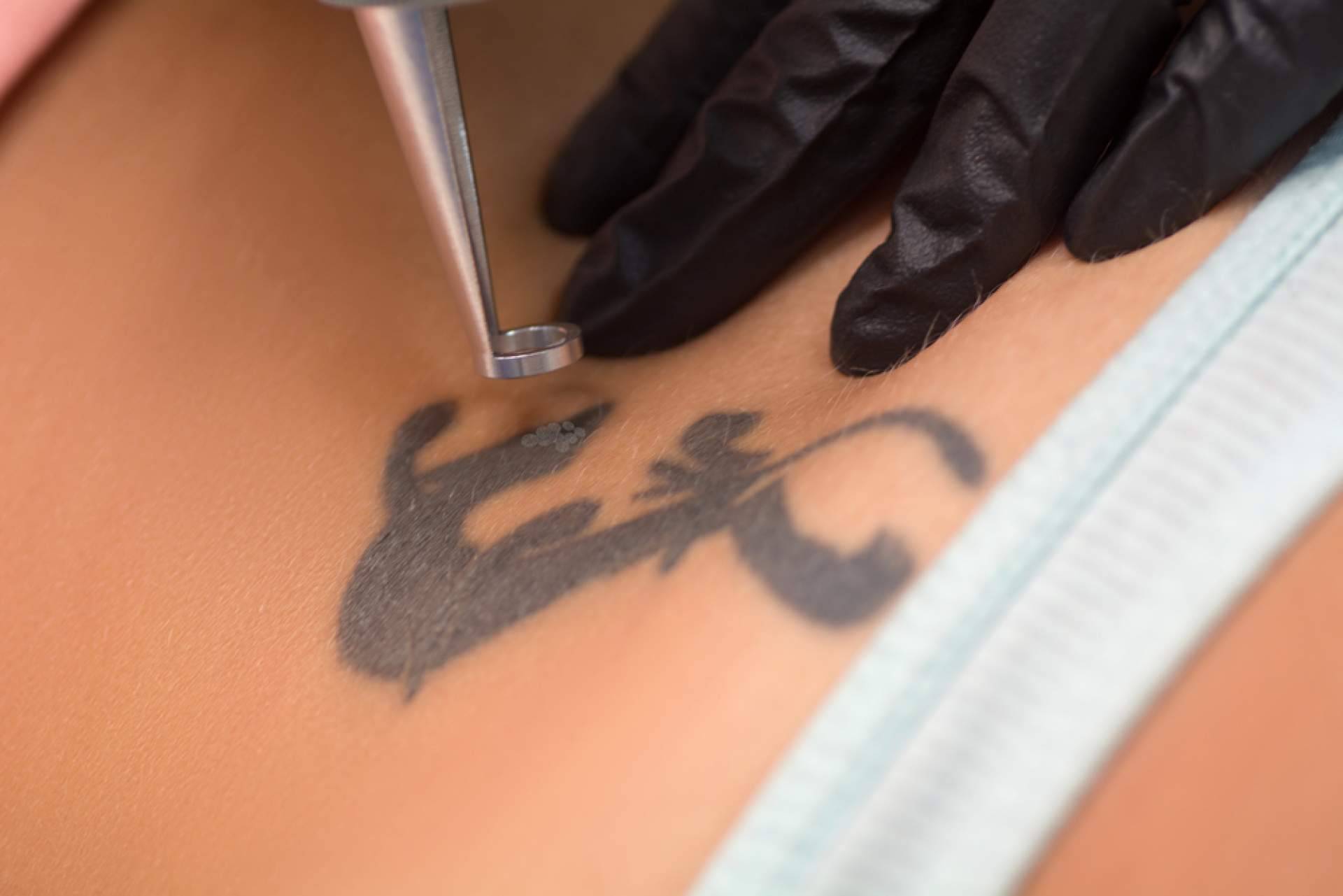 Eliminar tatuajes a color ya es posible de la mano de Ink Láser Alicante