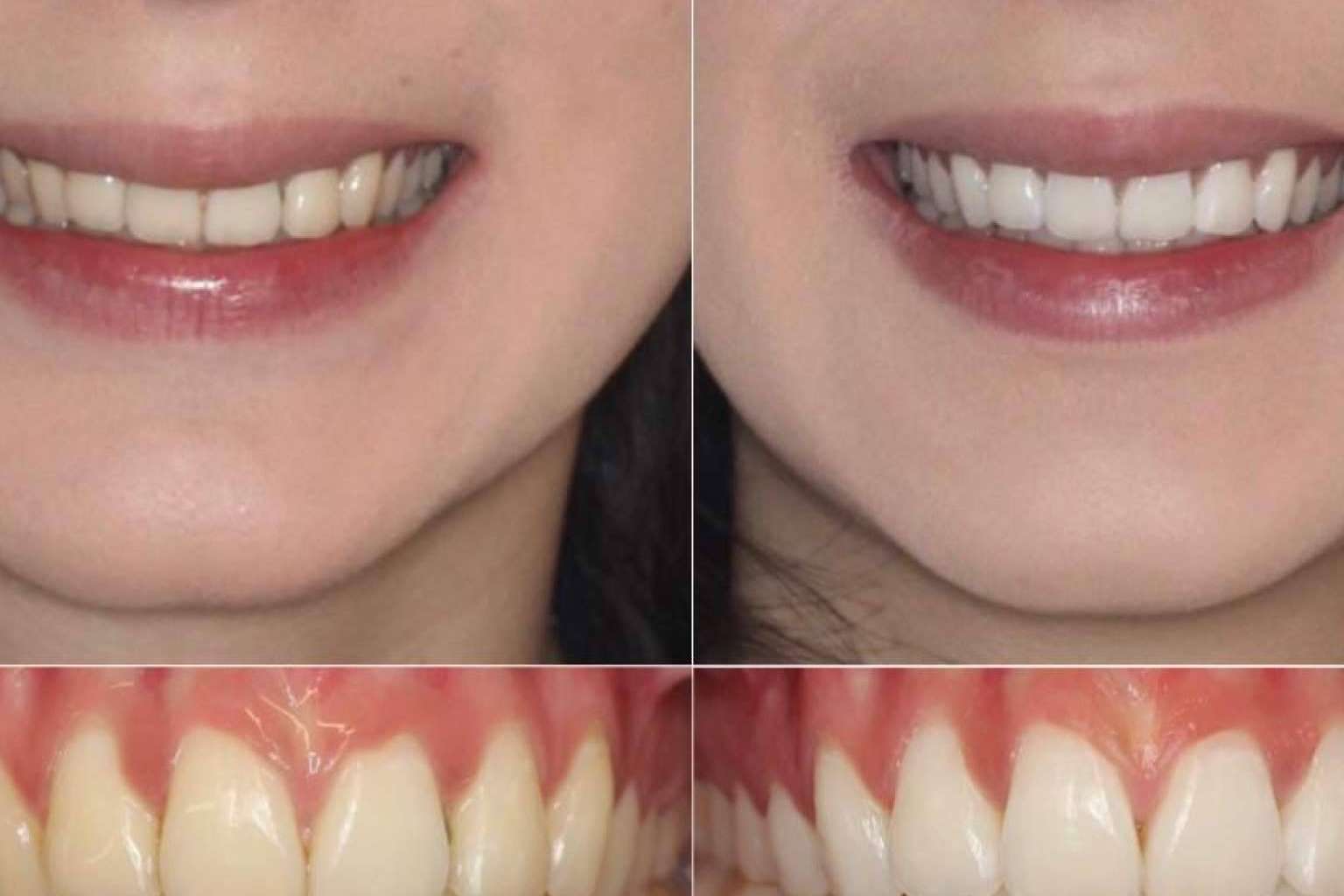 ¿Qué servicios de blanqueamientos dentales ofrece la Clínica Zahara?