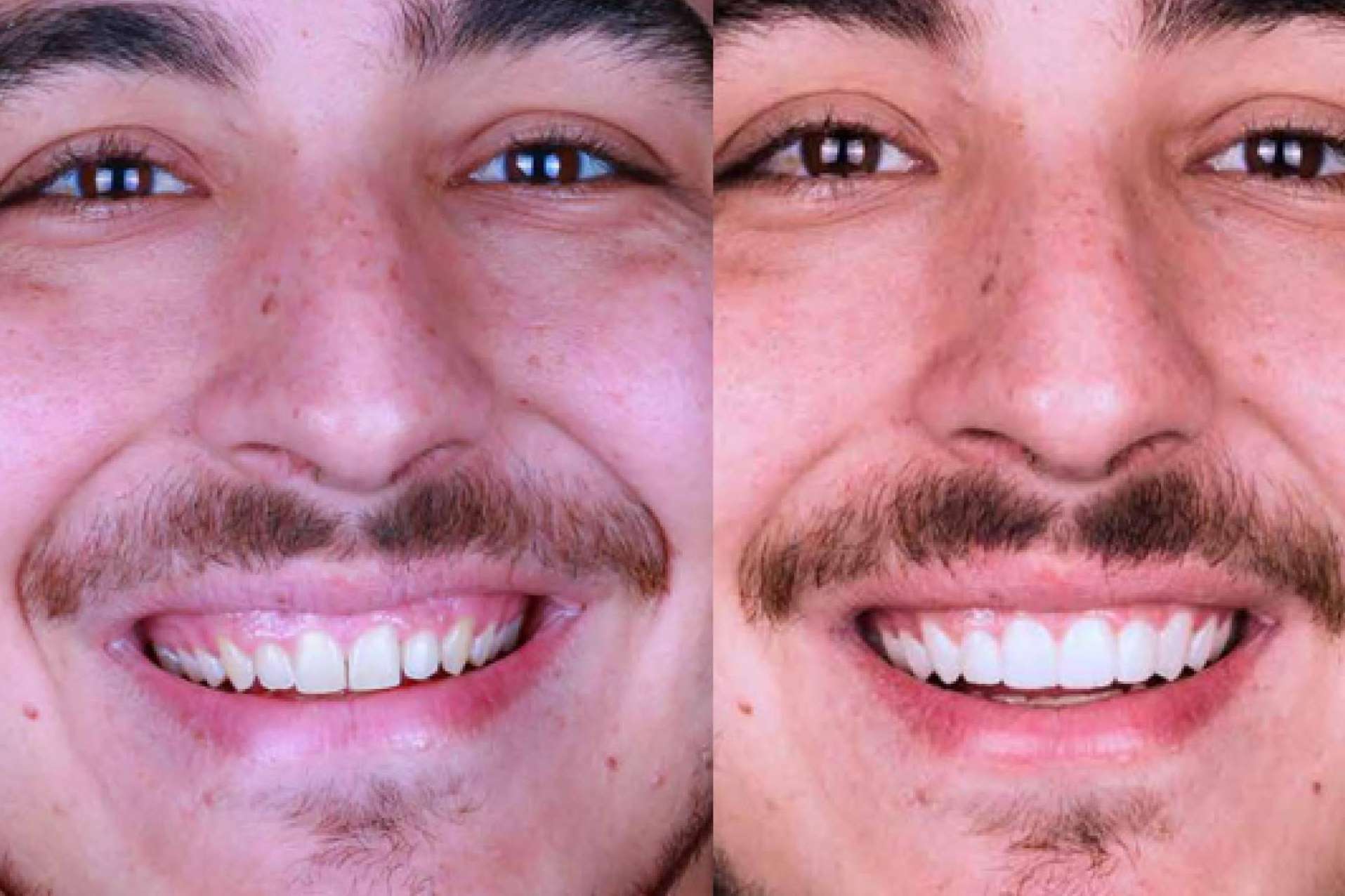Carillas estéticas, revolución en el cuidado dental para conseguir una sonrisa estilo Hollywood