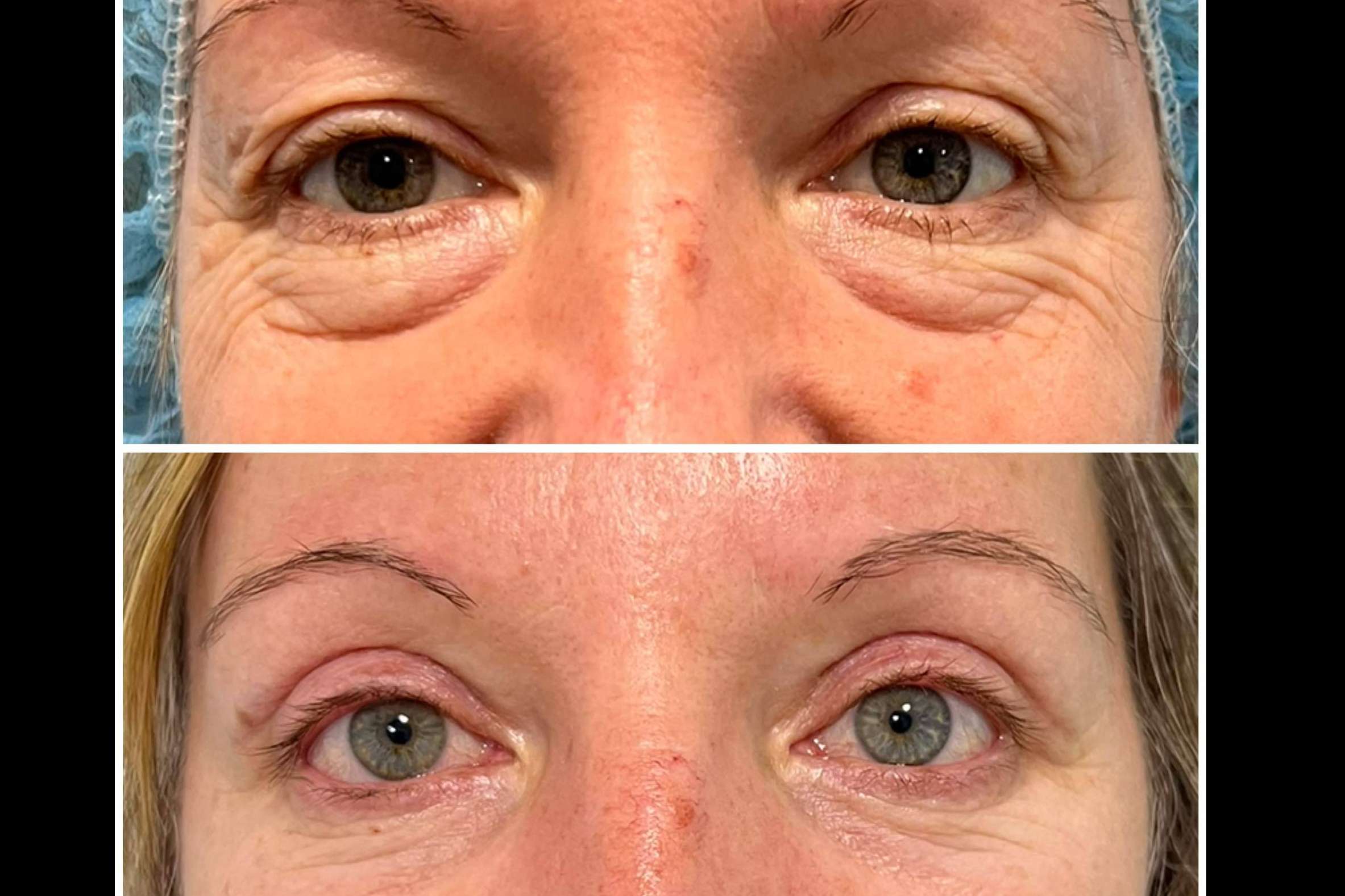 Eliminar los párpados caídos y rejuvenecer la mirada con la blefaroplastia, por Clínica Jiménez Ortiz