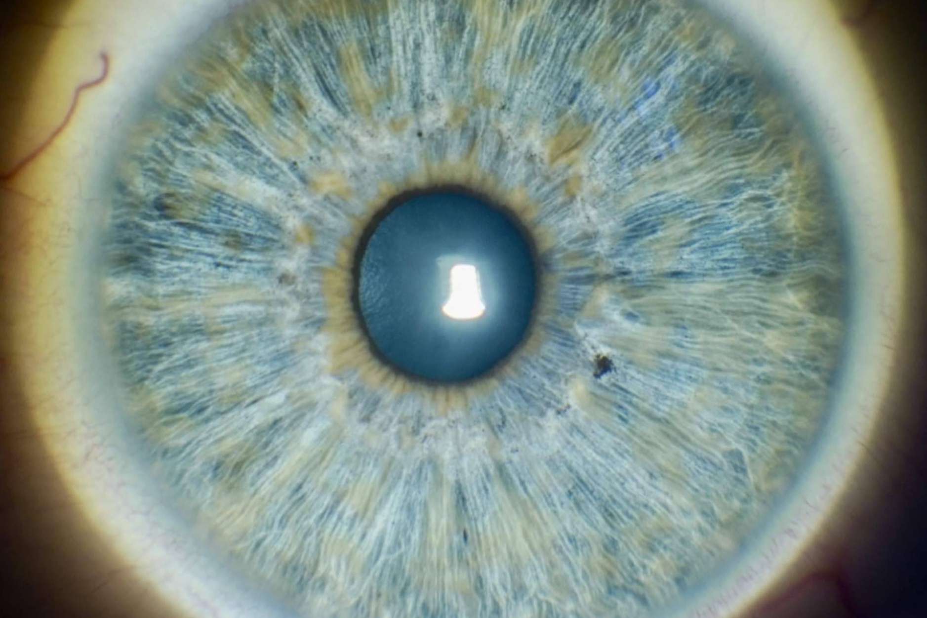 Cambiar el color de los ojos de manera segura y eficaz con la técnica New Eyes Laser de la Clinica Eyecos