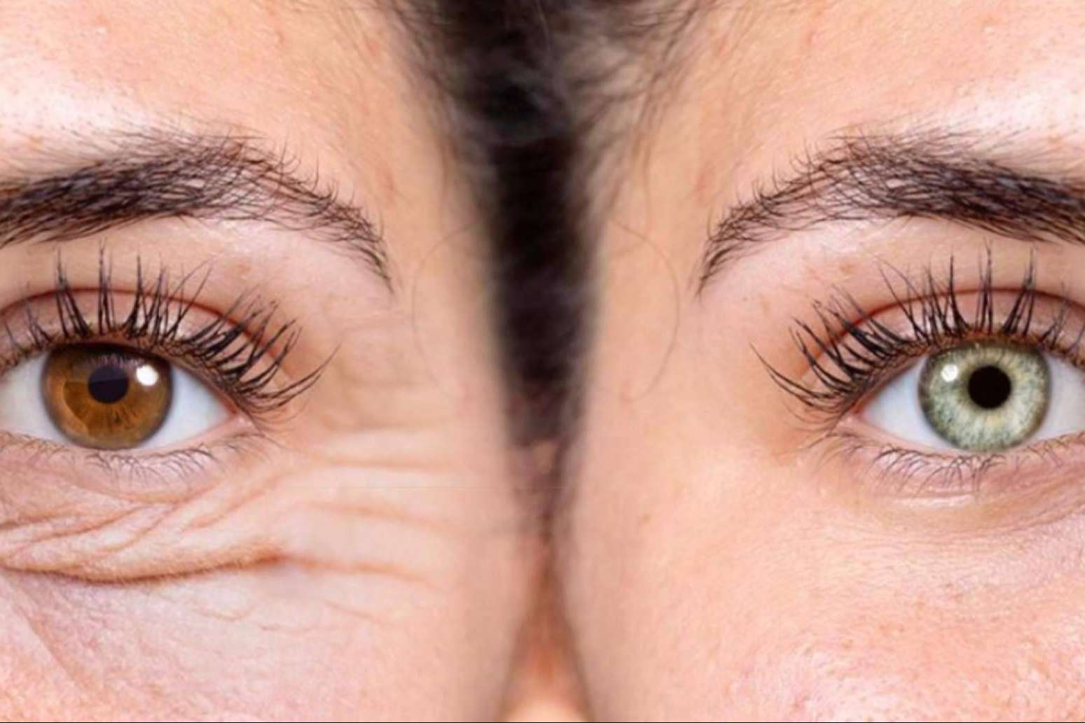 Nuevo color de ojos y blefaroplastia láser; el paquete especial de Clínica Eyecos para un cambio de mirada completo