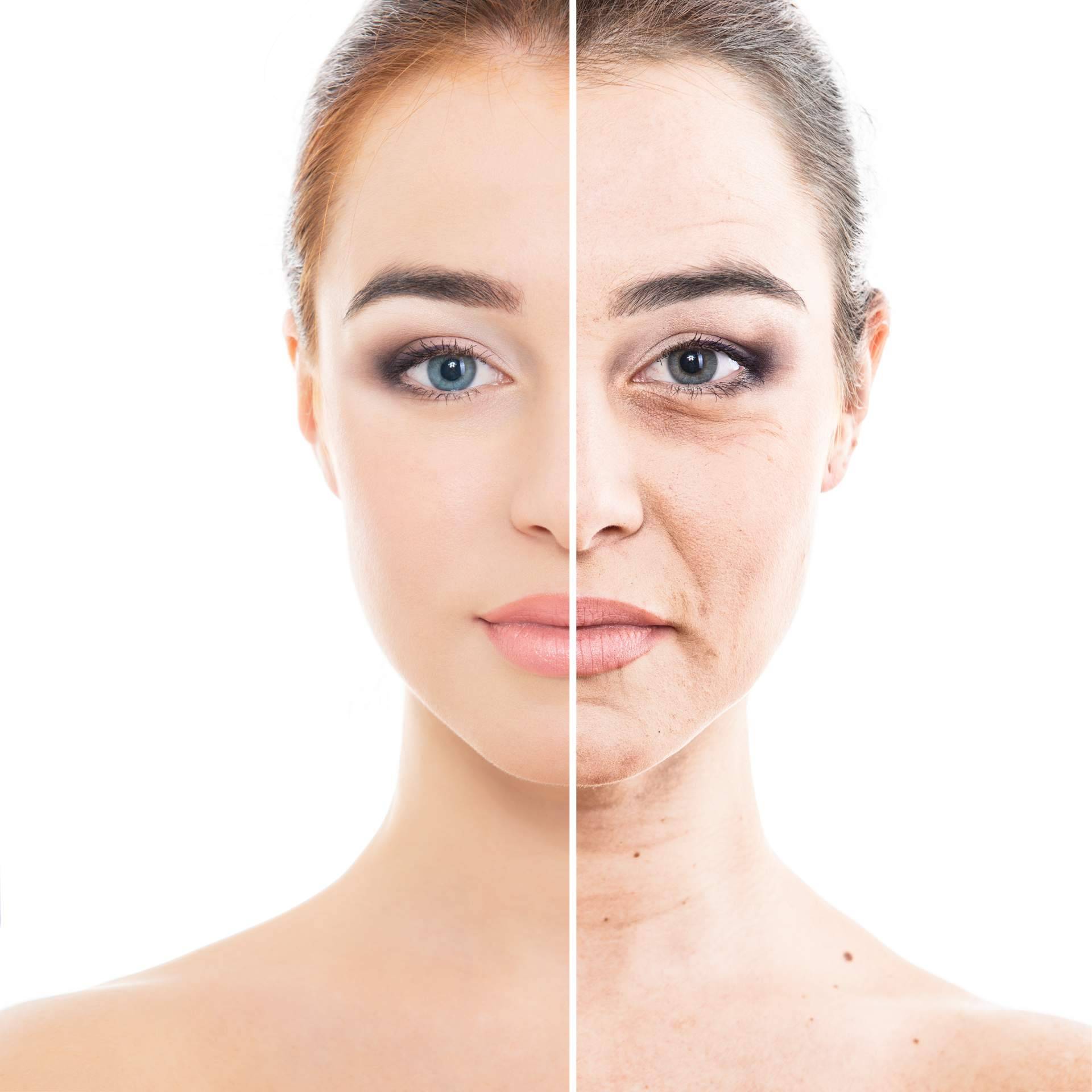 Eliminar las ojeras con ácido hialurónico, en Centro Estética El Pilar