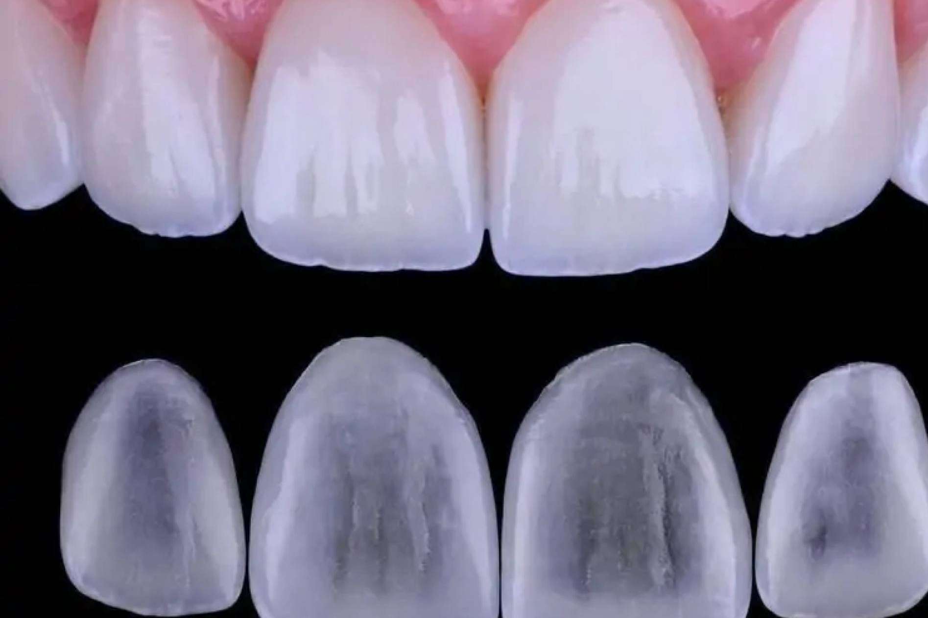 La colocación de las carillas de cerámica con lo último en tecnología