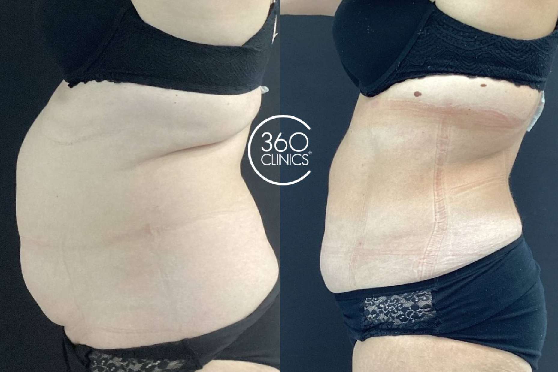 Innovación estética en 360Clinics con Lipo Láserfit Medical, el futuro de los tratamientos corporales sin cirugía