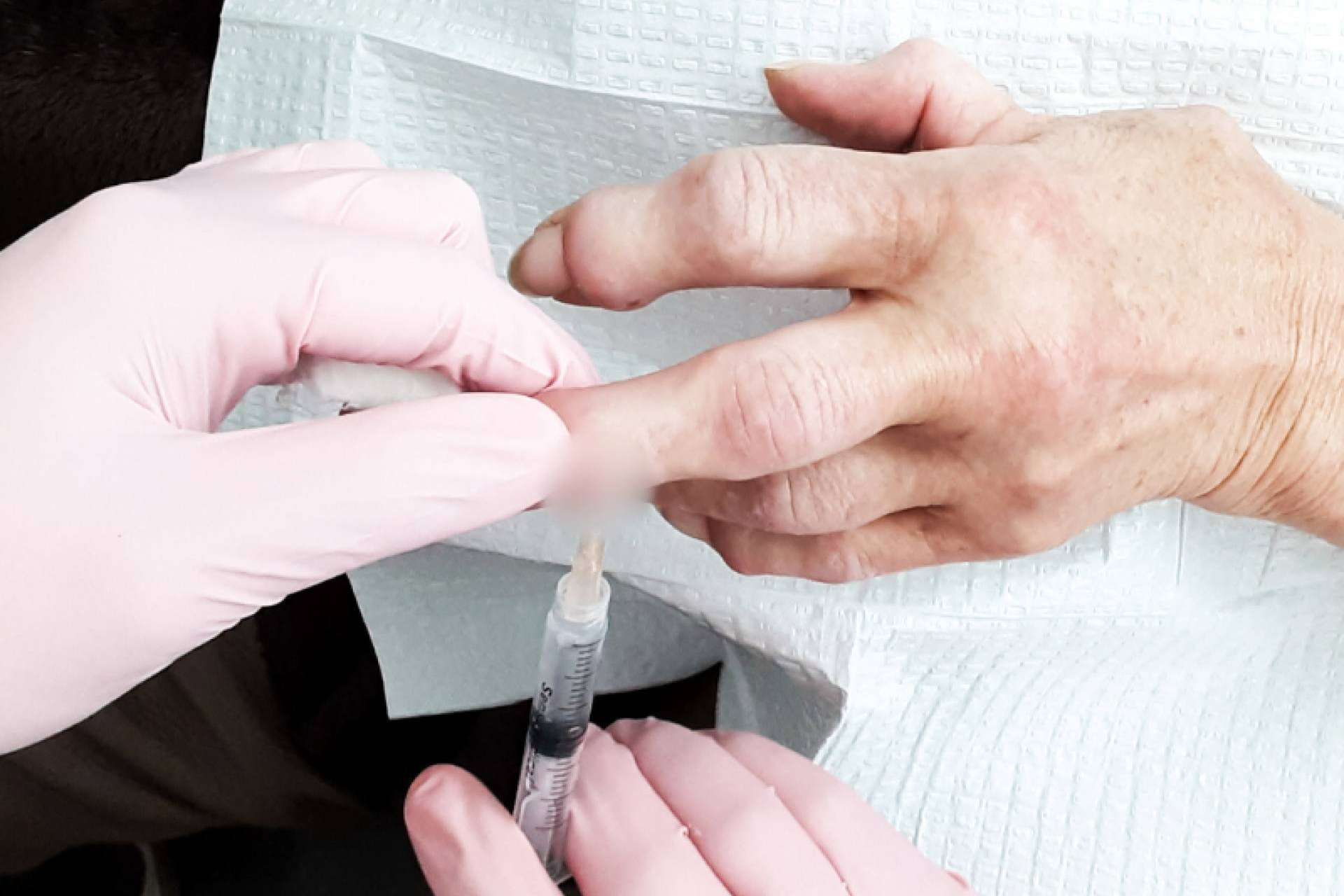 Cómo una paciente con artritis reumatoide mejoró gracias al tratamiento con células madre en la medicina regenerativa