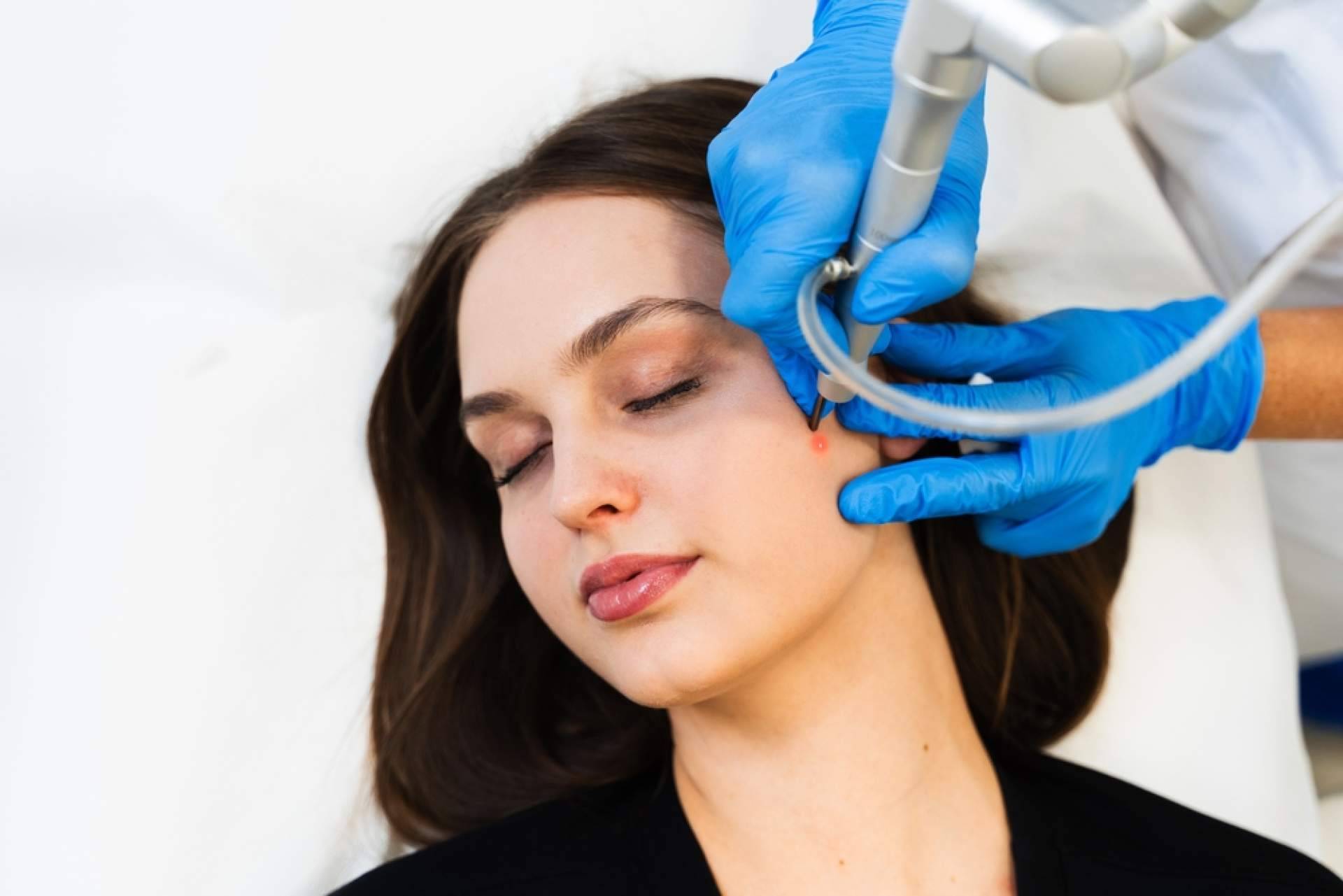 Centro Estética El Pilar ofrece soluciones avanzadas para la eliminación de lunares y verrugas sin cirugía