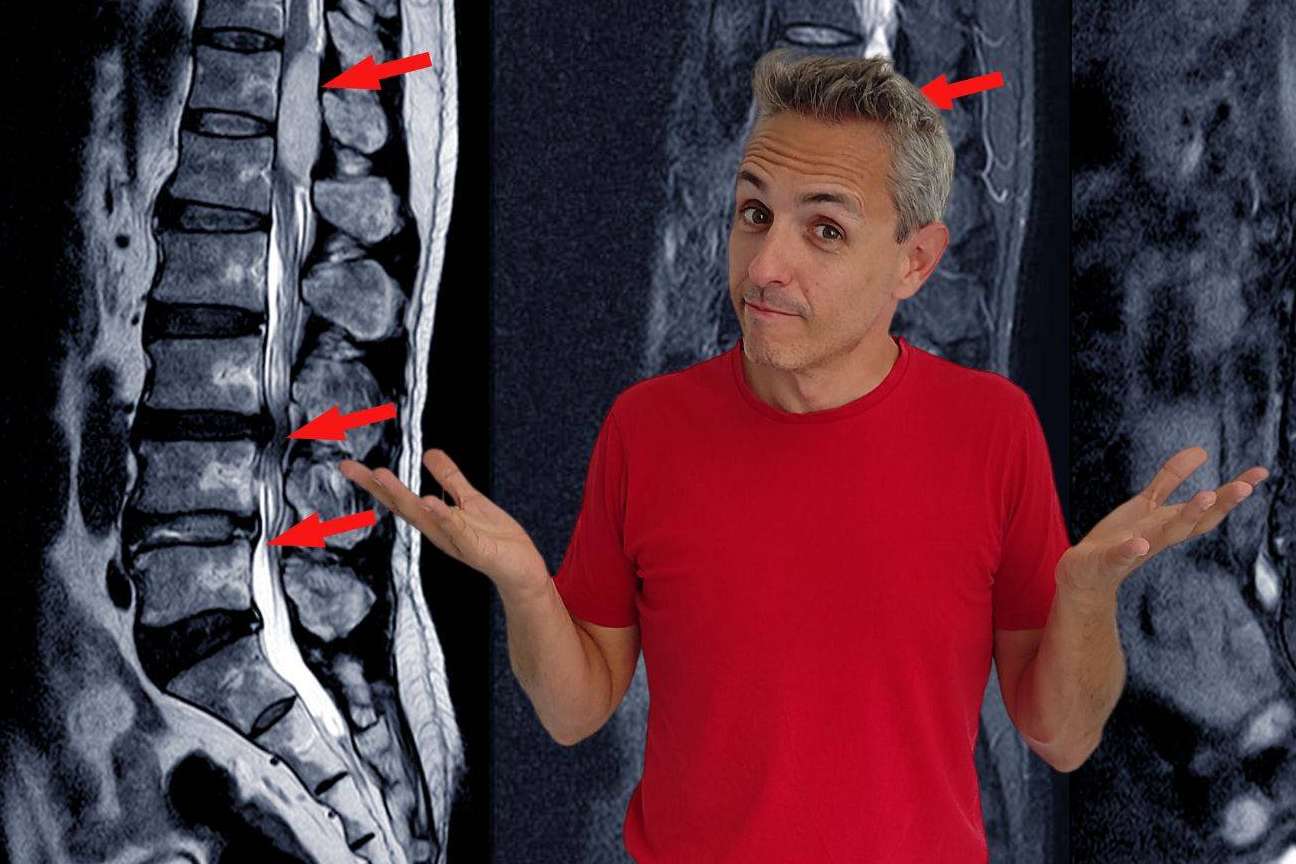 Roberto Galván explica cuál es el enfoque más eficaz para el tratamiento de la hernia discal L5-S1