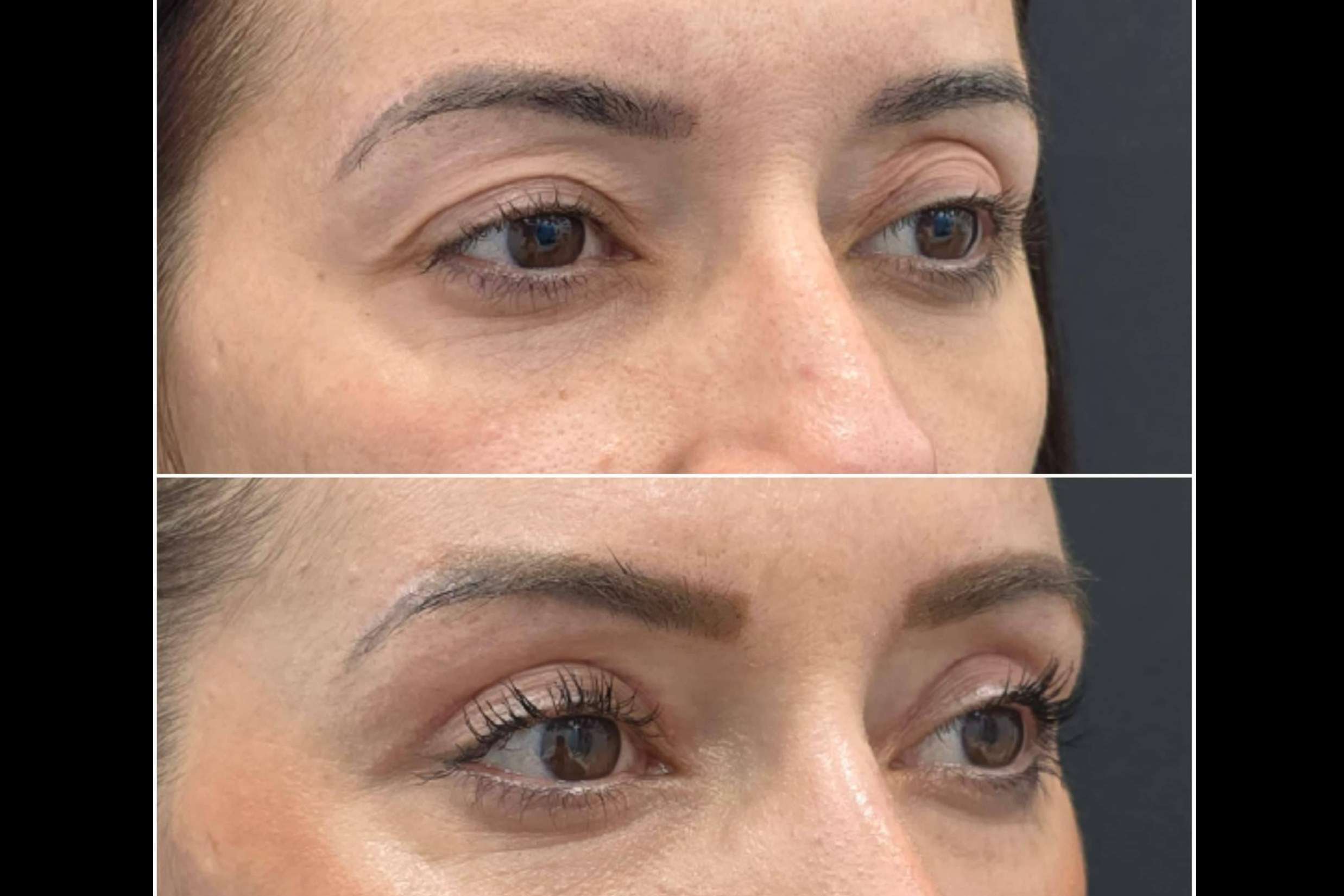 EyeEvolution360, la blefaroplastia sin hospitalización y con un protocolo post-operatorio único