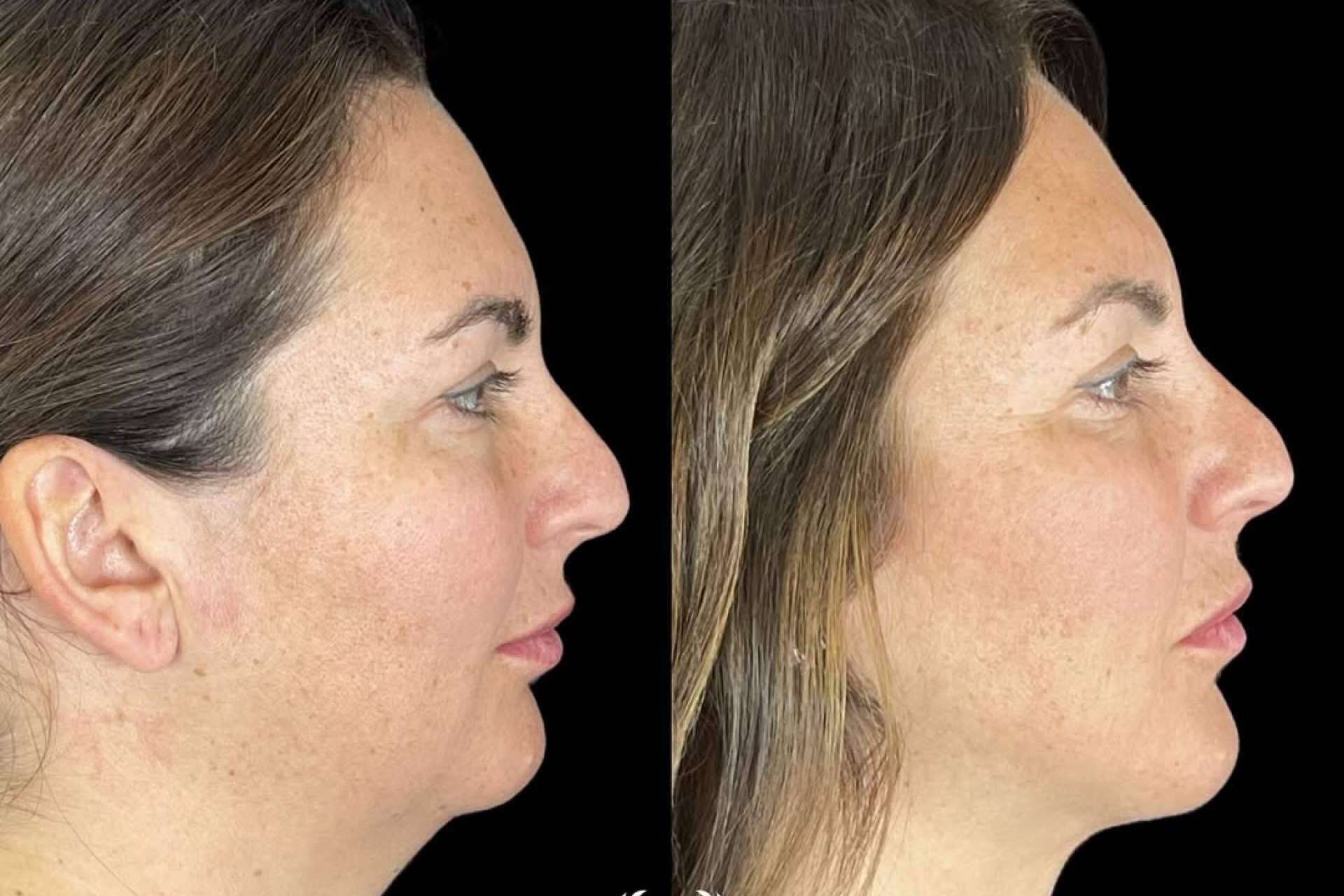 Descubrir la lipopapada en Clínica Roma