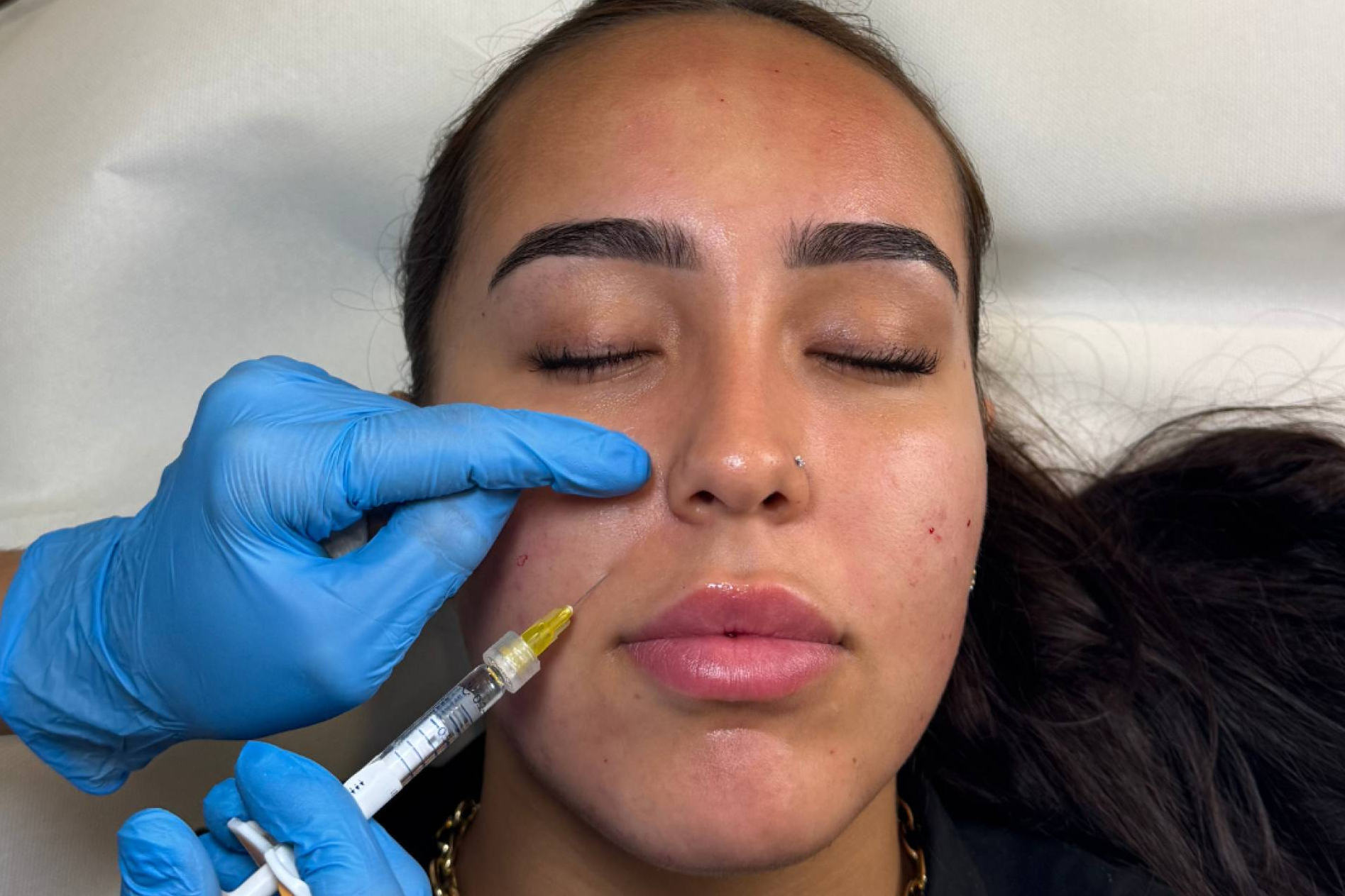 La ciencia del Skinbooster; ácido hialurónico que refuerza la piel desde el interior