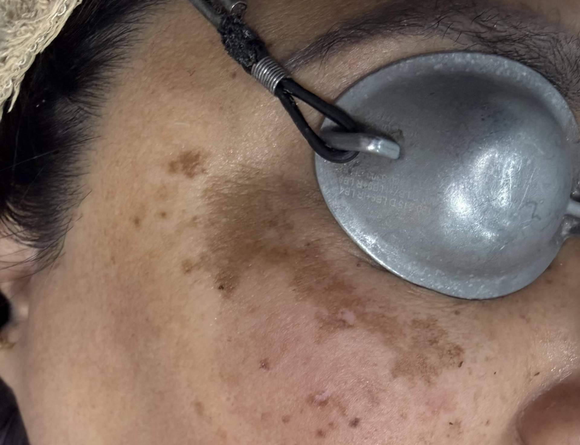 Factores agravantes y alimentación en el melasma, la Dra. Janeth Arévalo ofrece orientación clínica