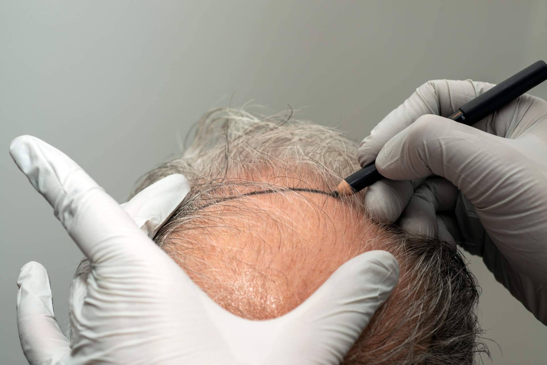 El trasplante capilar con cirugía natural, la especialidad del Dr. Jesús Aníbal Mora en Madrid