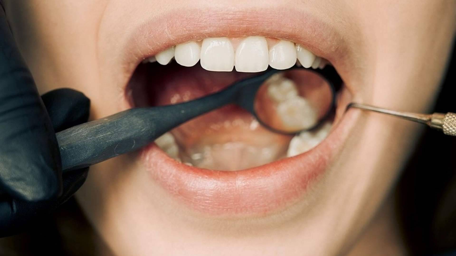 Carillas dentales y prótesis fija sin metal; la tendencia hacia una sonrisa más natural